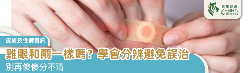 雞眼和繭一樣嗎？學會分辨避免誤治