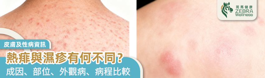 熱痱與濕疹有何不同？