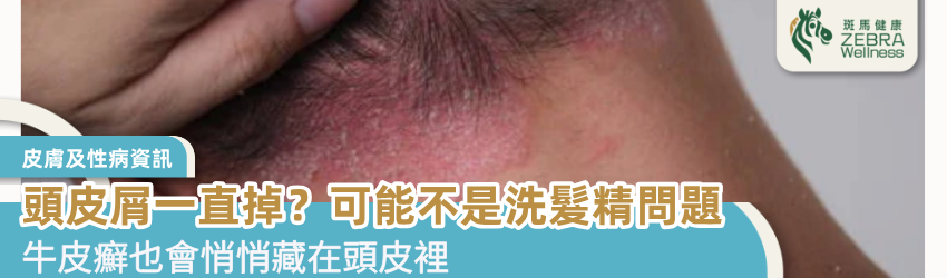 頭皮屑一直掉？可能不是洗髮精問題