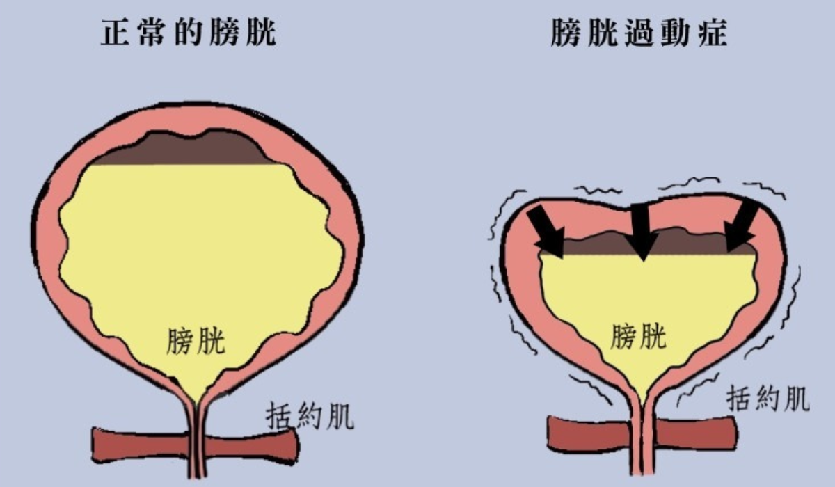 揭秘膀胱過動症的4大症狀