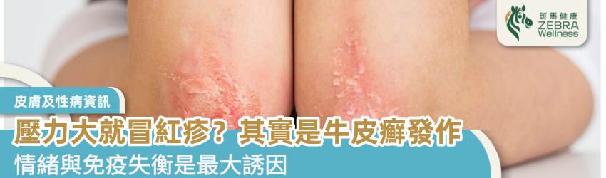 壓力大就冒紅疹？其實是牛皮癬發作