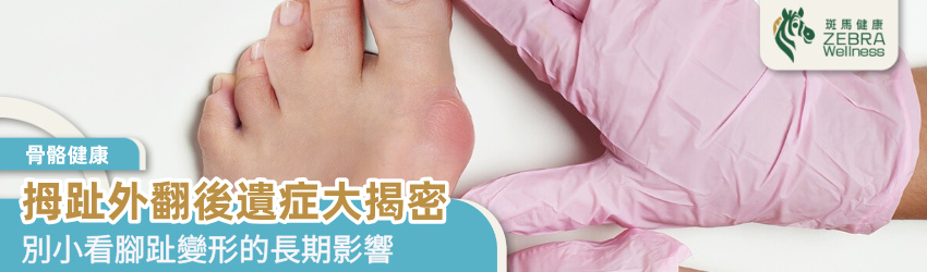拇趾外翻後遺症大揭密