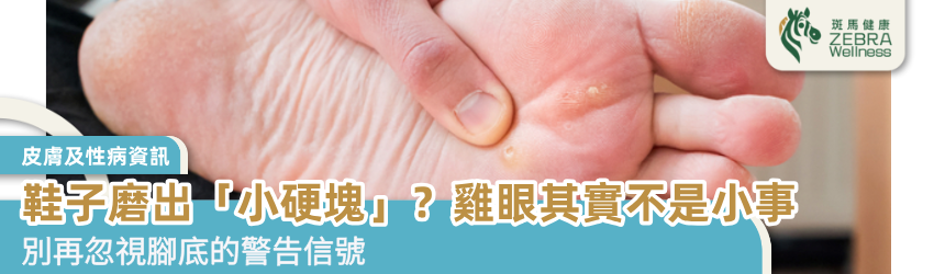 鞋子磨出「小硬塊」？雞眼其實不是小事