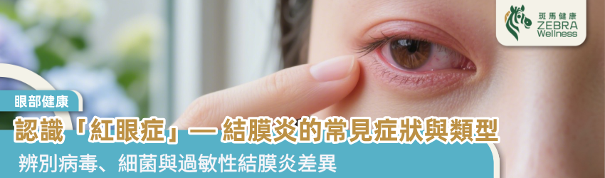 認識「紅眼症」— 結膜炎的常見症狀與類型