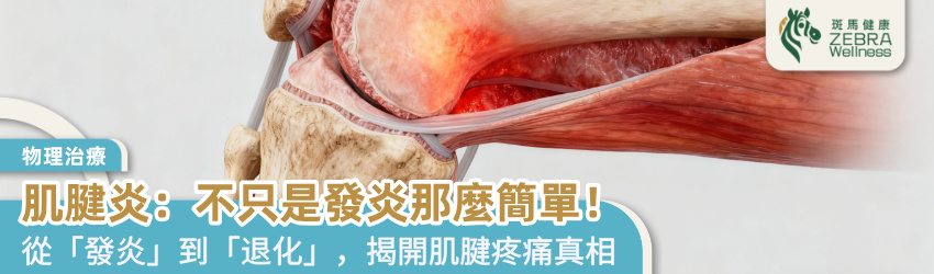 肌腱炎：不只是發炎那麼簡單！