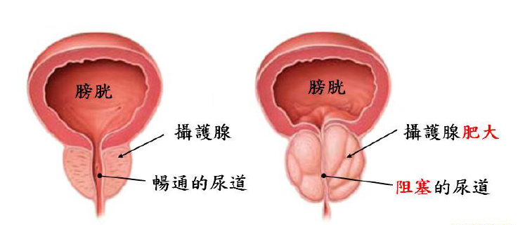 前列腺肥大的症狀