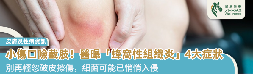 小傷口險截肢！醫曝「蜂窩性組織炎」4大症狀 